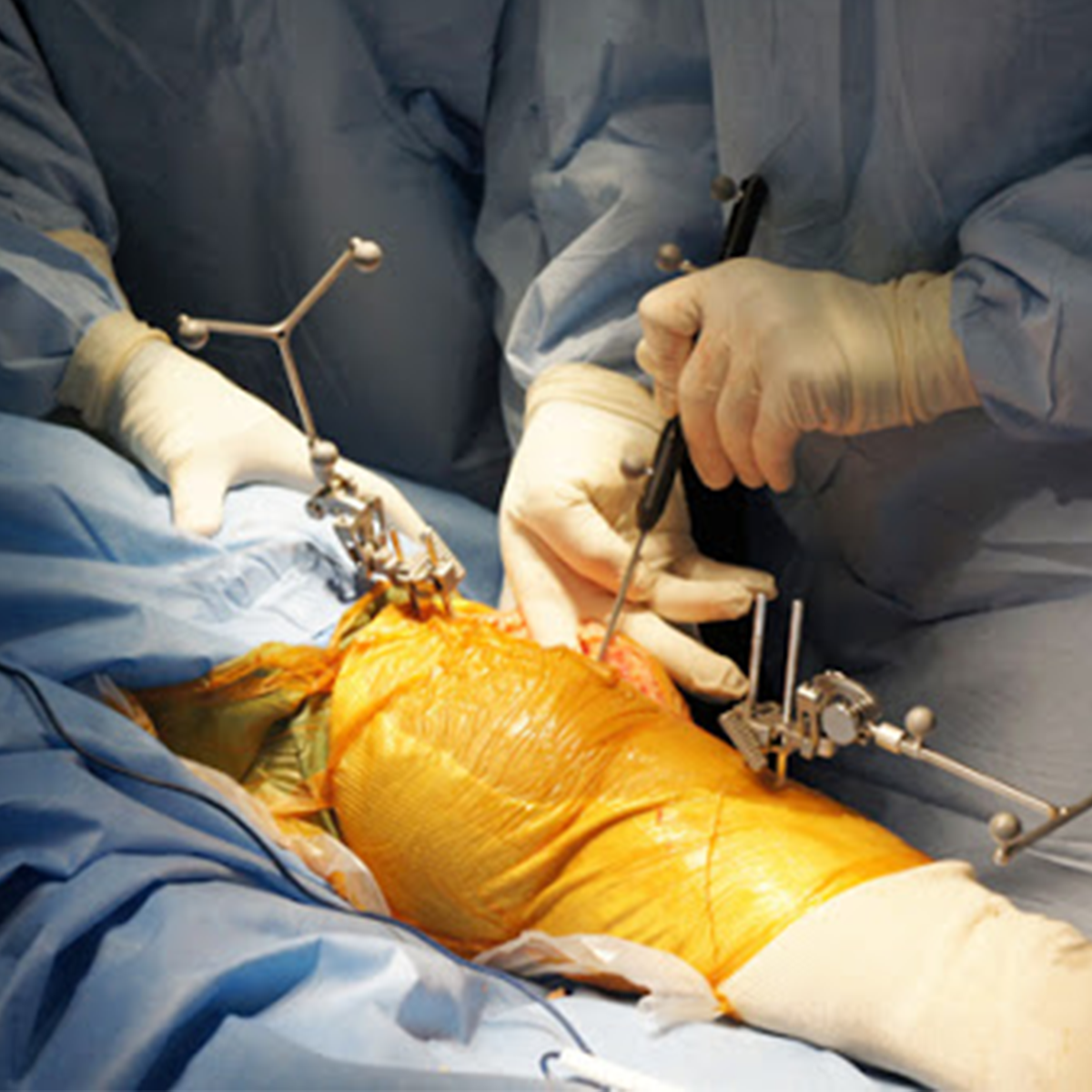 JOINT REPLACEMENT SURGERY